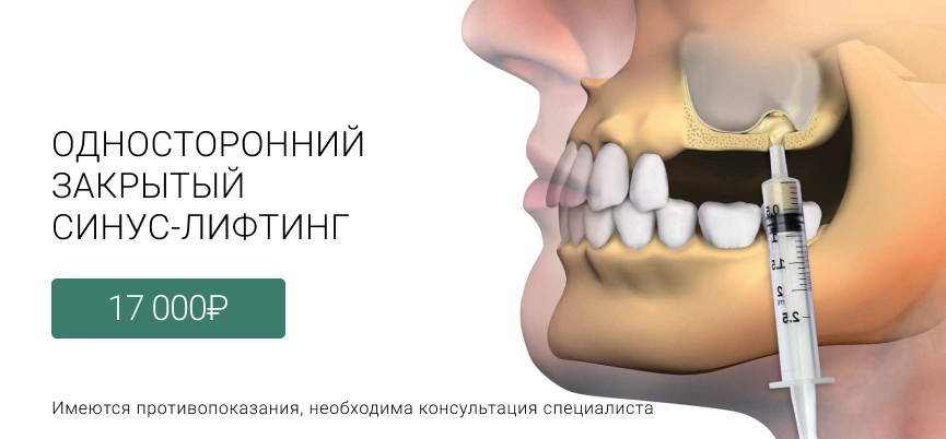 Синуслифтинг закрытый Маршала Казакова 72