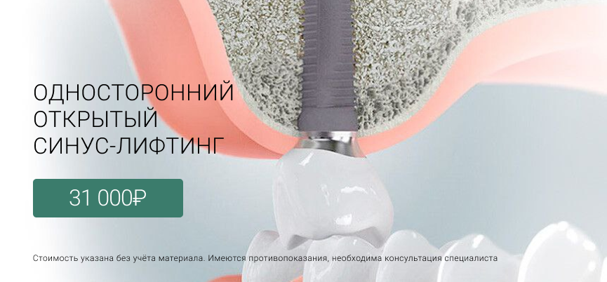 Синуслифтинг открытый Маршала Казакова 72