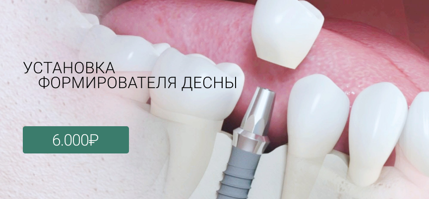 Установка формирователя десны Маршала Казакова 72